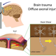 Illustration for article titled Why a Head Injury Can Be Far Worse Than You Realize